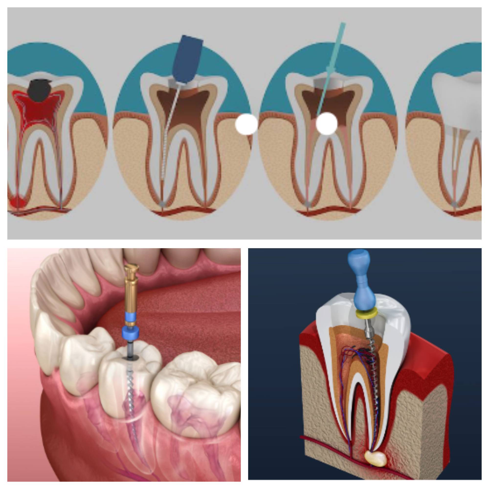 Unveiling The Truth About Root Canal Treatment : Myths And Facts