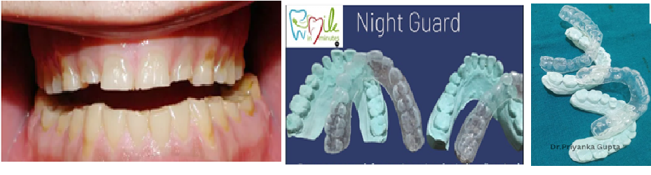 Are Night Guards Are The Solution For Bruxism: All You Should Know About Night Guard