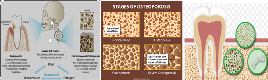 The Link Between Osteoporosis And Oral Health